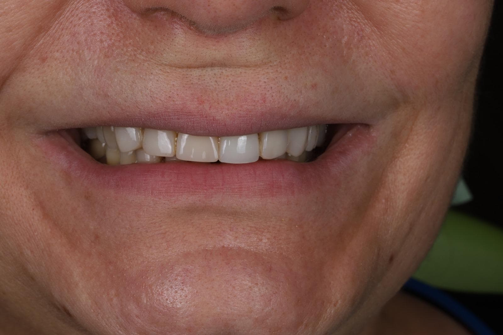 After — single tooth implant crown restored