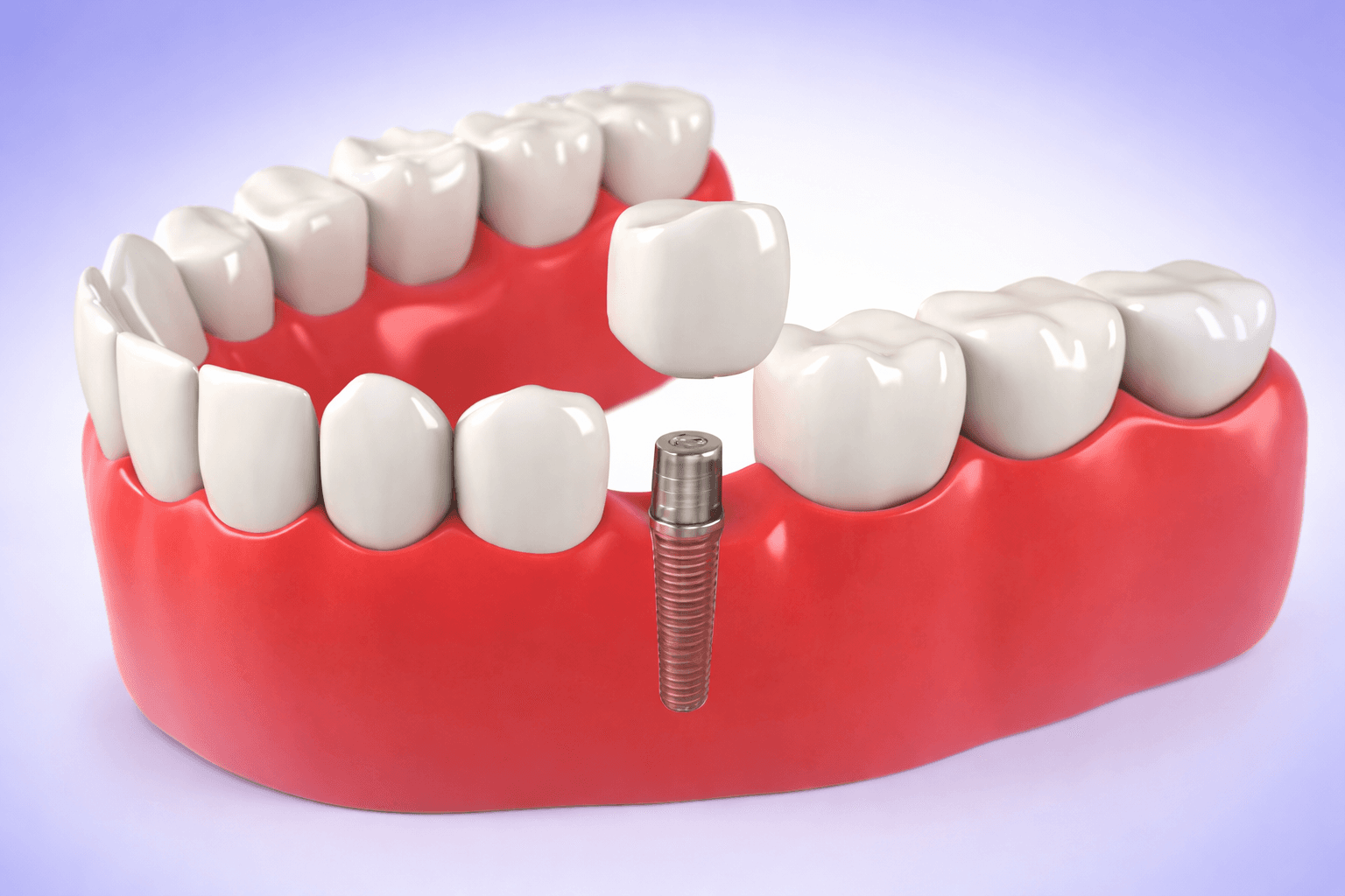 Dental Implant Procedure Step by Step