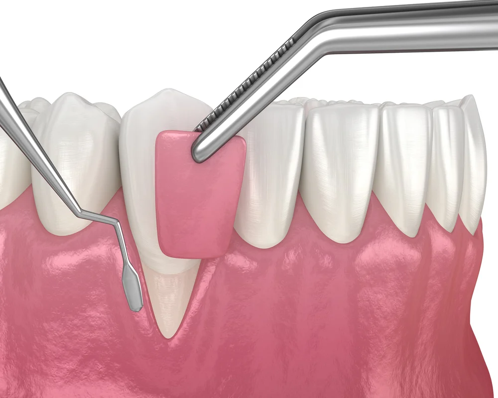 Types of Periodontal Disease