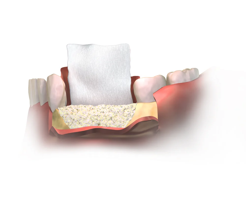 Signs & Symptoms of Periodontal Disease