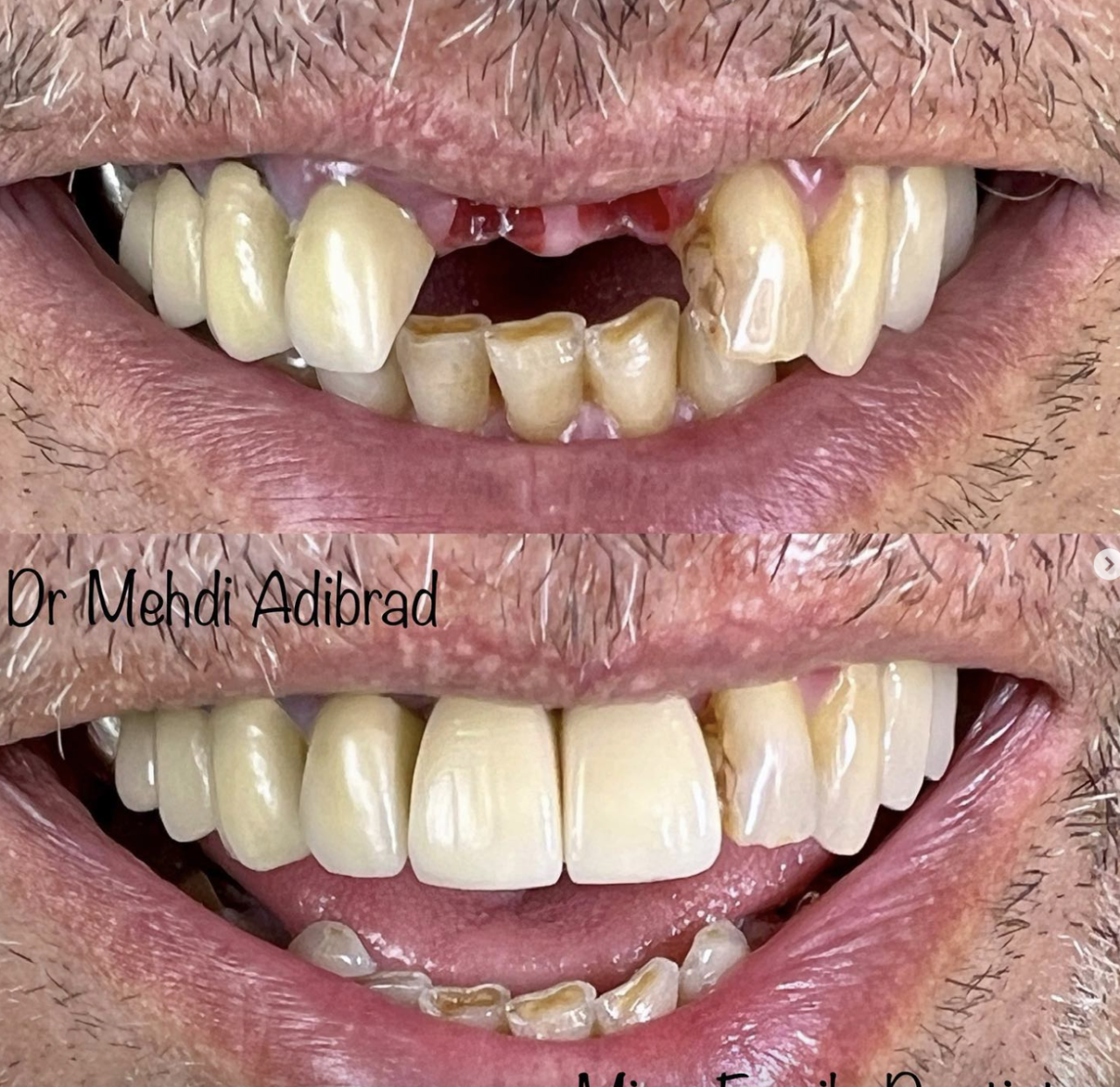 Dental Implant in Vaughan