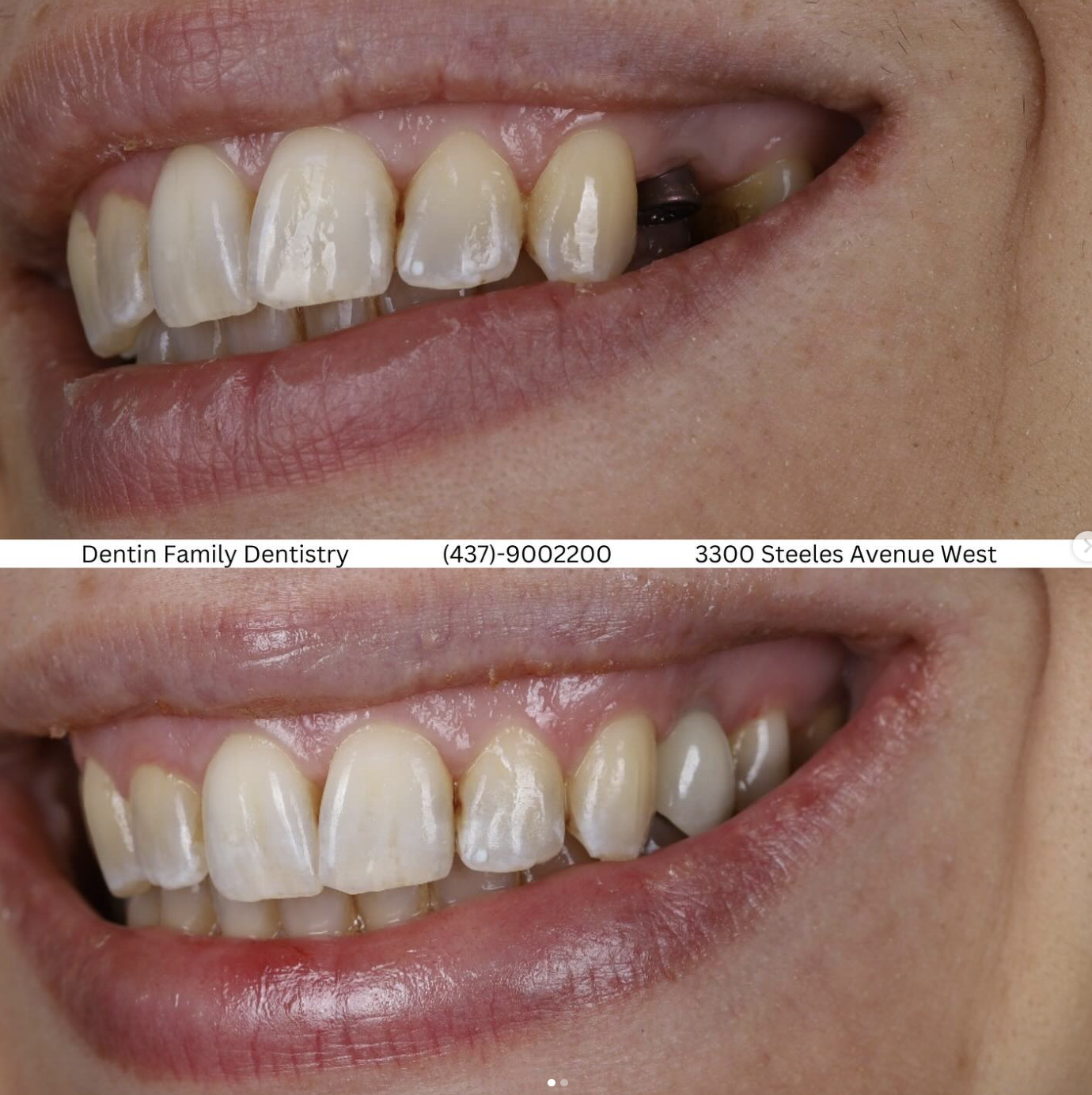 Single tooth implant at dentin family dentistry