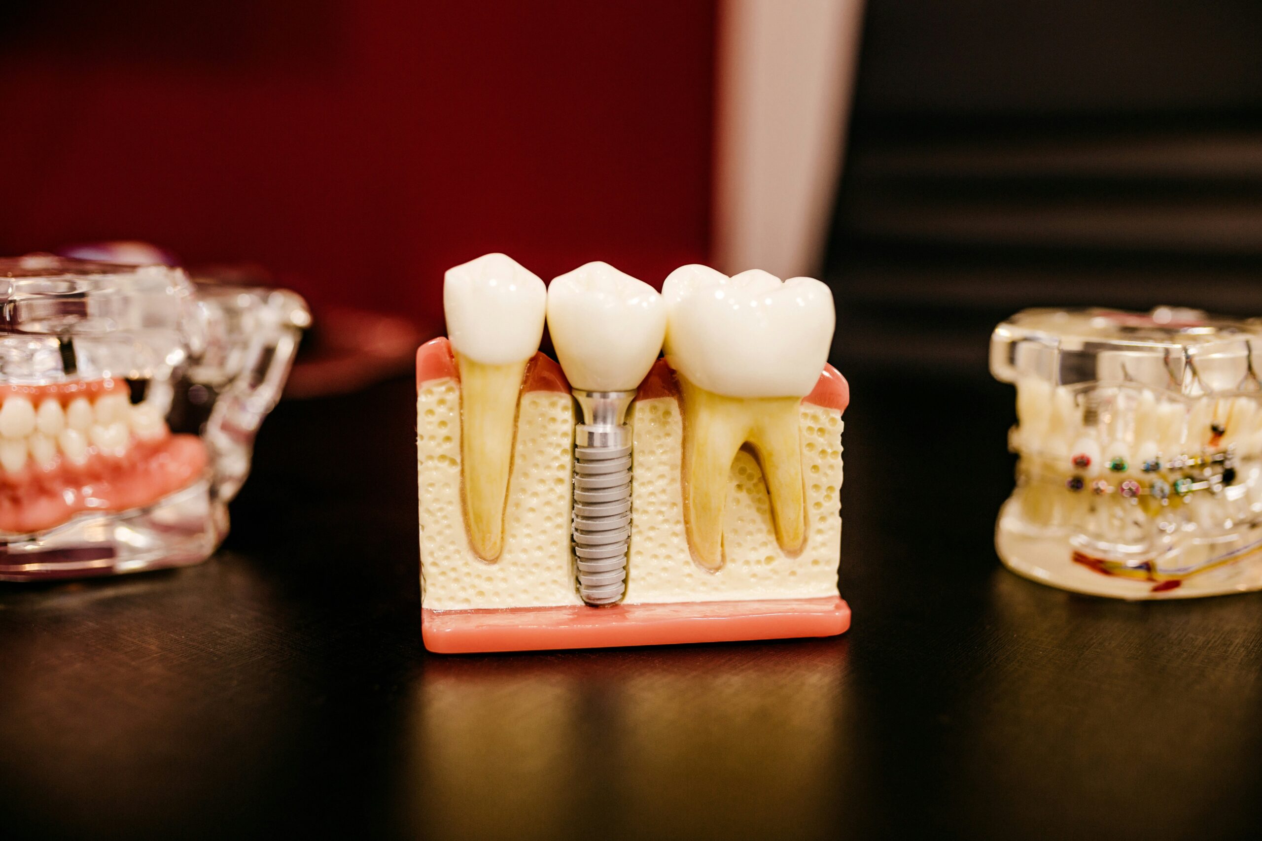 Vaughan Dental implant