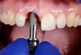 https://dfdentistry.ca/wp-content/uploads/2025/02/dental-implants-1-2-1.webp