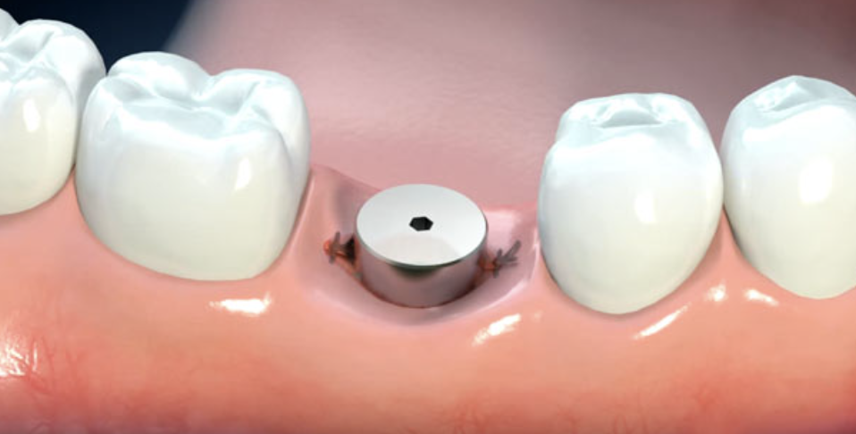 dental healing after implant