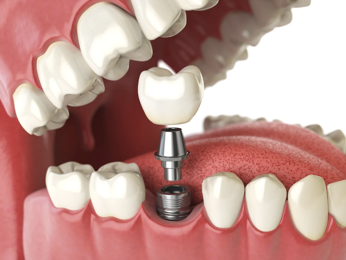 Single Tooth implant