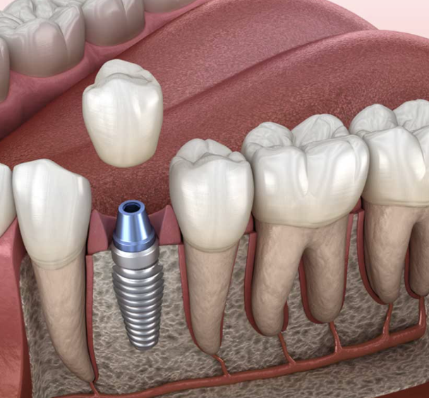 Single tooth implant