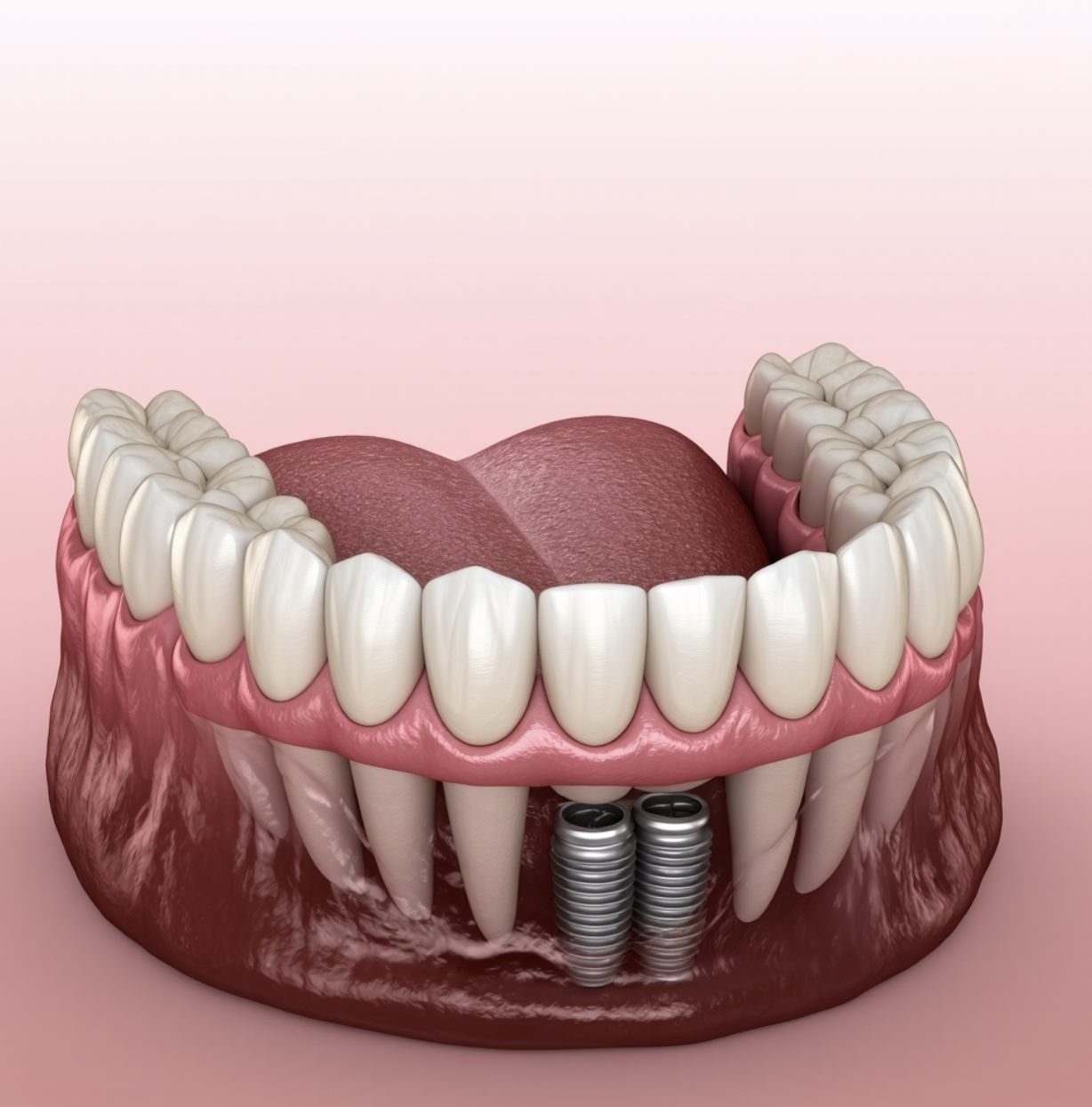 after dental implant