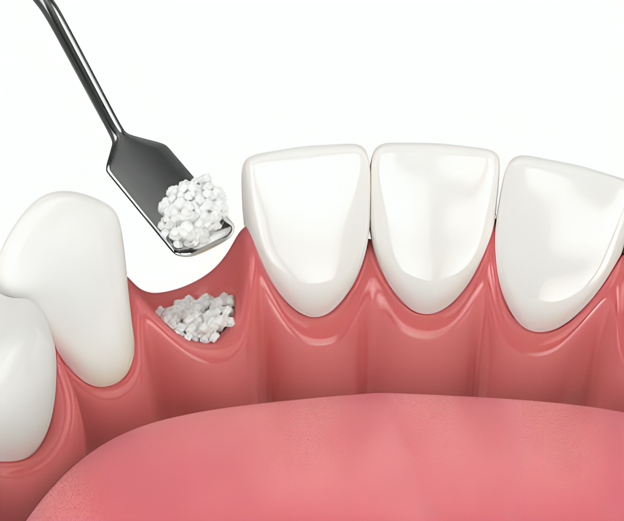 bone grafting for a missing tooth