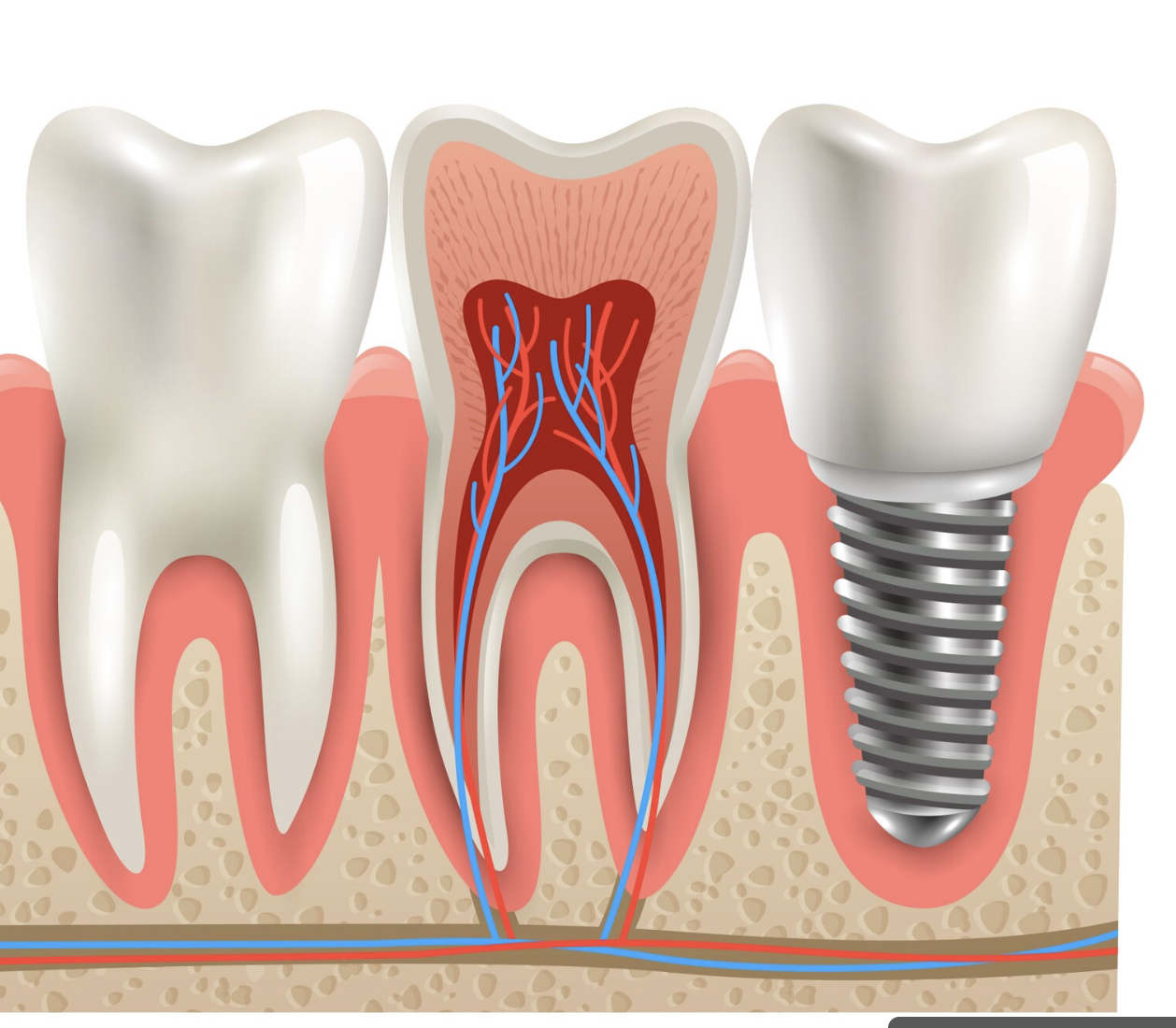 dental implant procedure at dentin family dentistry