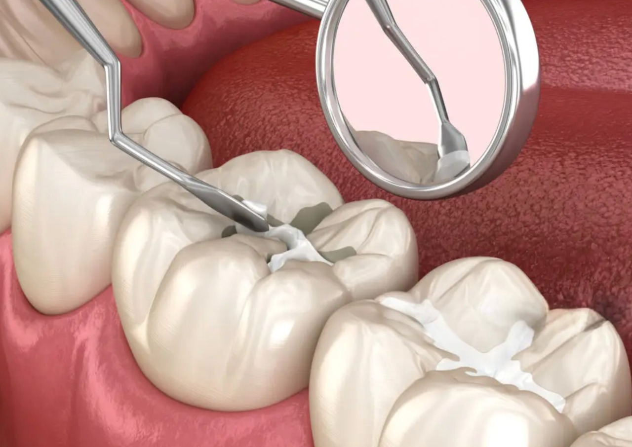 https://dfdentistry.ca/wp-content/uploads/2025/03/fissure.png