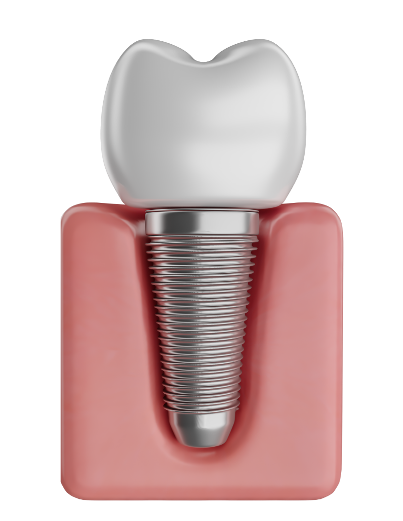 Dental implant in vaughan