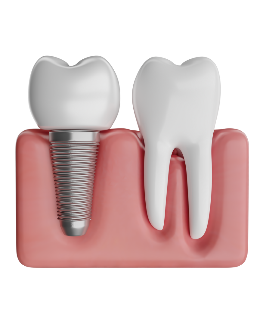 affordable dental implants