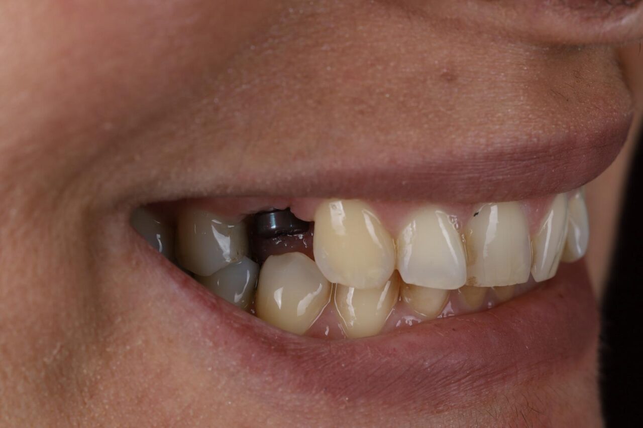 Implant and Laminate Veneers