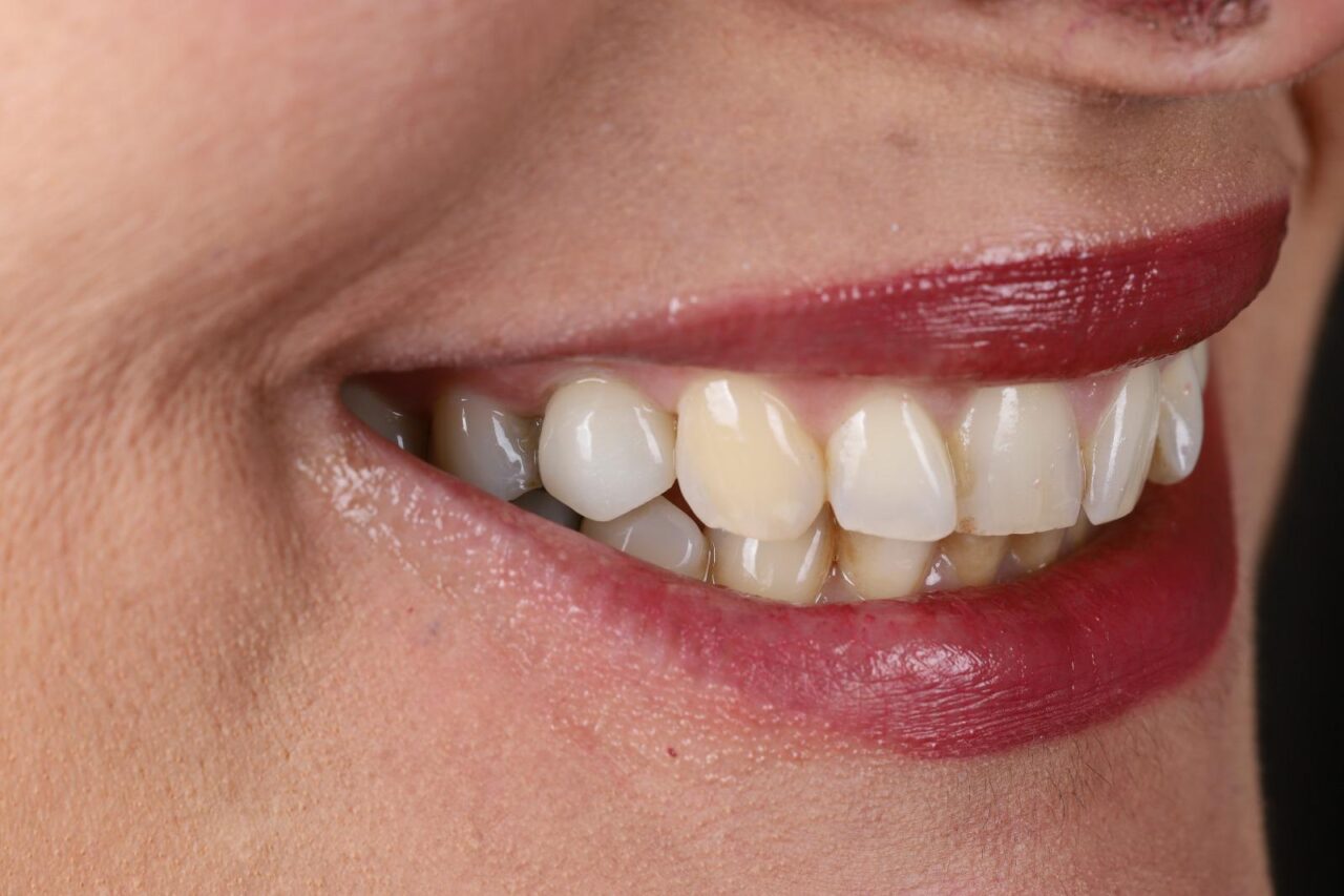 Implant and Laminate Veneers