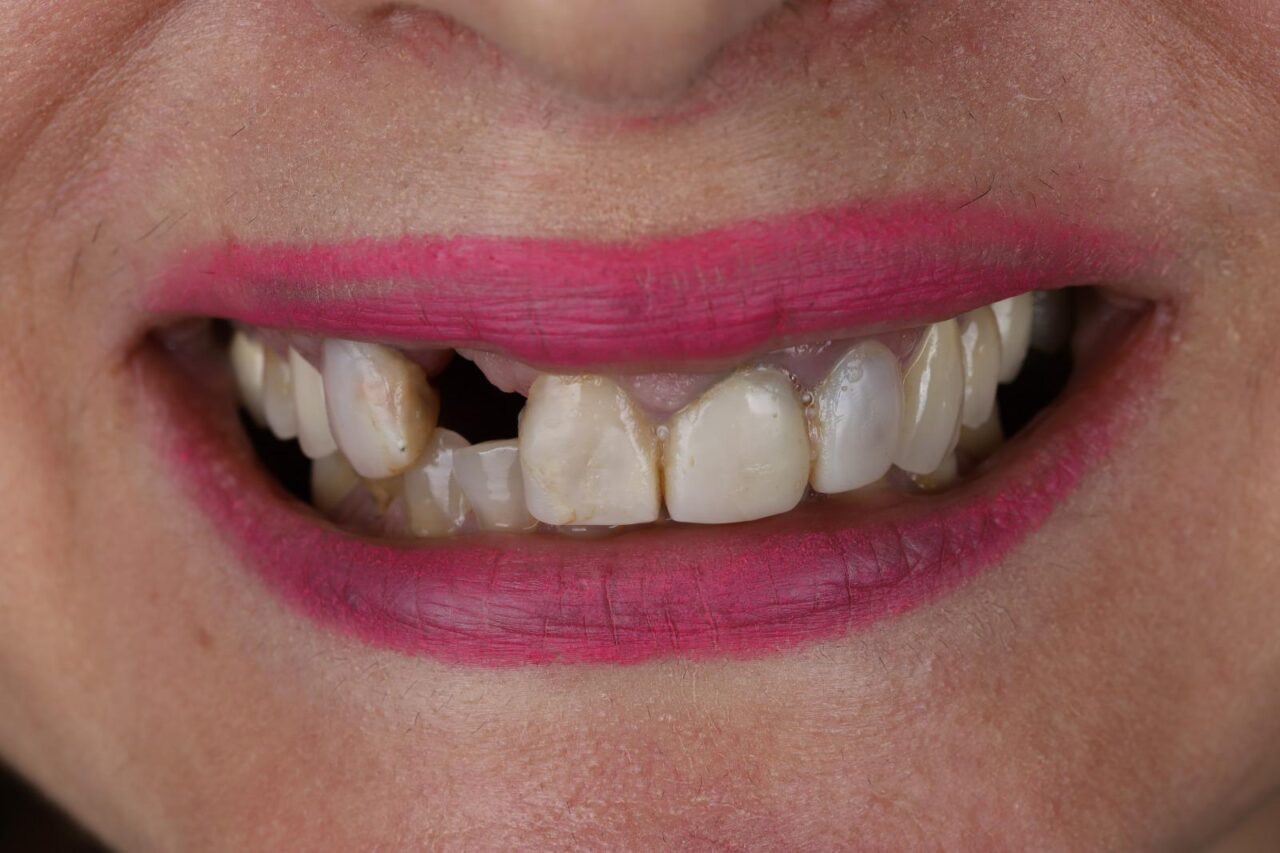 Implant and Laminate Veneers