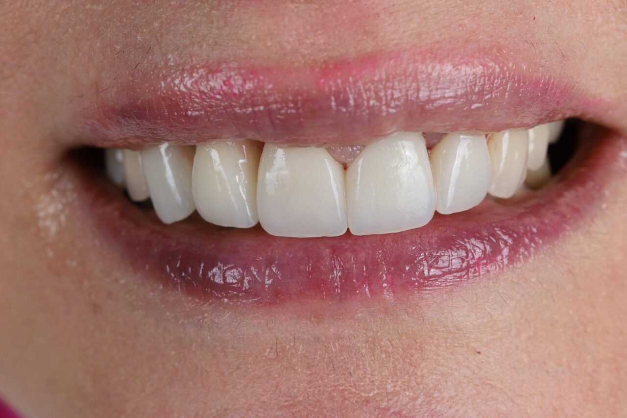 Implant and Laminate Veneers