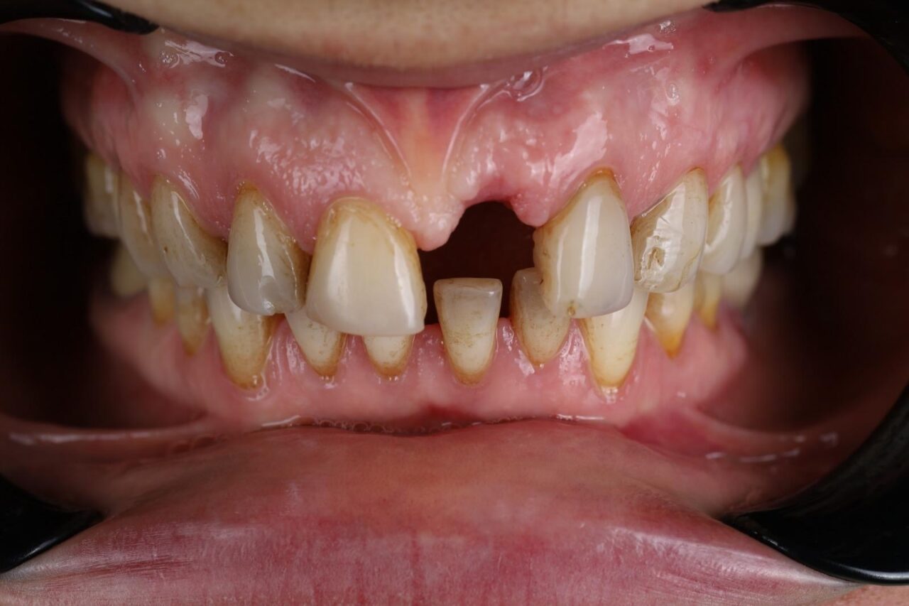 implant and composite veneers (before)