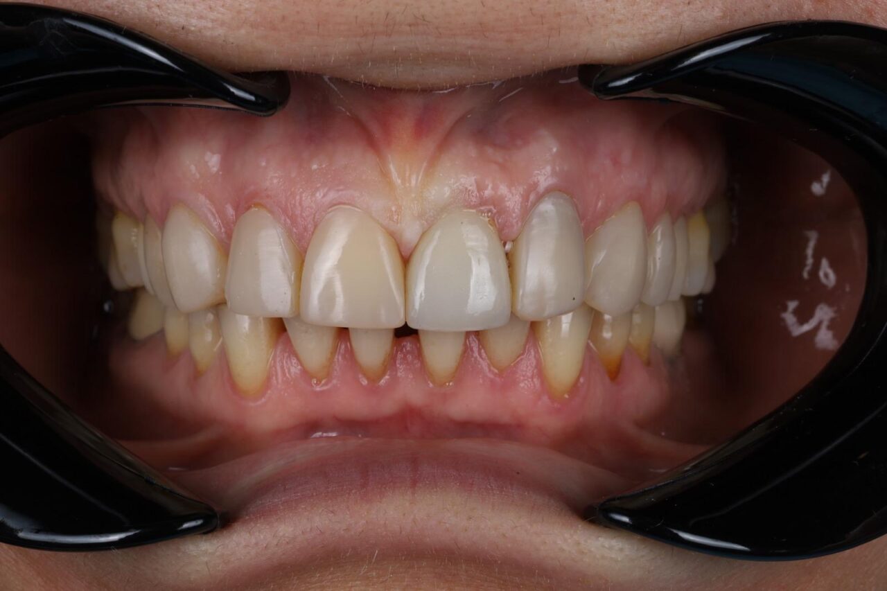 Implant and Composite veneer (after)